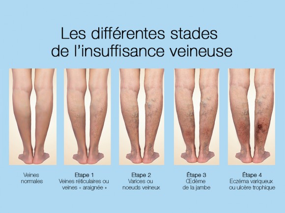 mauvaise circulation sanguine tete mauvaise circulation sanguine tete